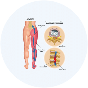 Medical vector graphic depiction of Sciatica